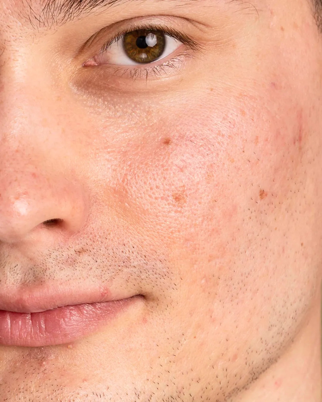 Peeling químico