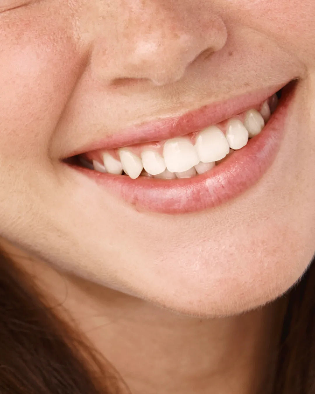 Sonrisa gingival