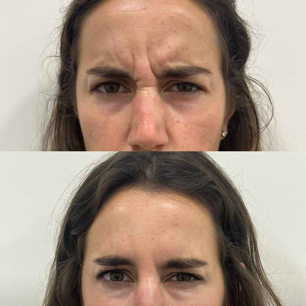 Comparativa antes y después de bótox en el entrecejo para suavizar arrugas de expresión y relajar el gesto facial.
