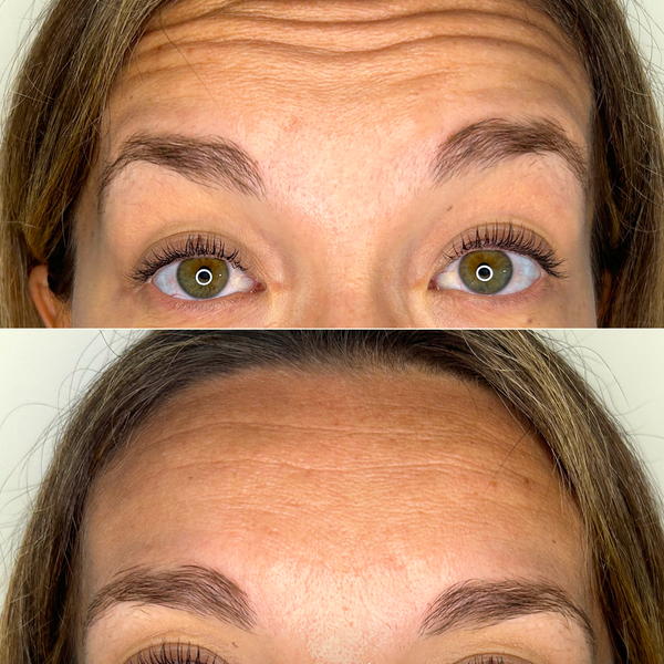 Comparativa antes y después de bótox en la frente para suavizar arrugas de expresión y mantener una mirada natural.