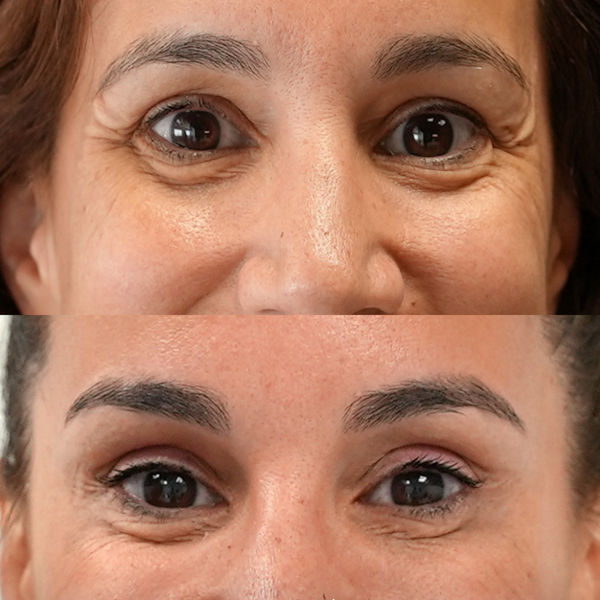 Comparativa antes y después de bótox facial en frente y entrecejo para suavizar arrugas de expresión y rejuvenecer la mirada.
