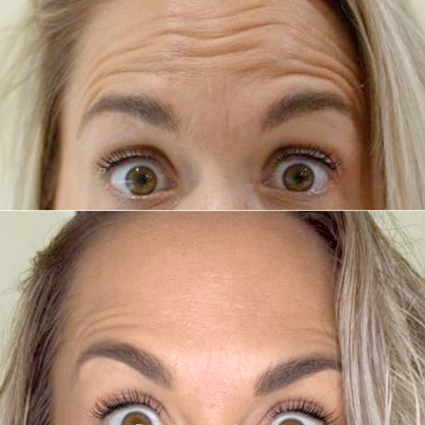 Resultado antes y después de bótox en la frente para reducir líneas horizontales y mantener una expresión natural.