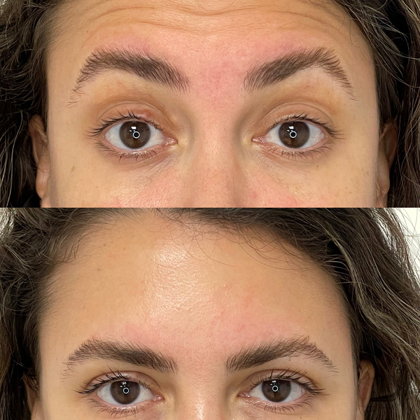 antes-despues-botox-frente-mirada-bloome.png
