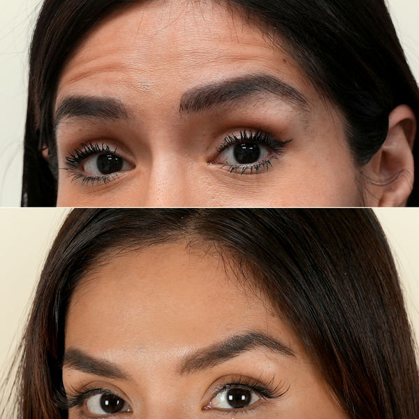 antes-despues-botox-mirada-cejas-bloome.png