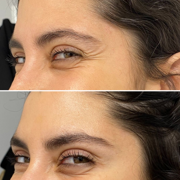 Antes y después de bótox en patas de gallo para suavizar arrugas de expresión en la zona periocular manteniendo un resultado natural.