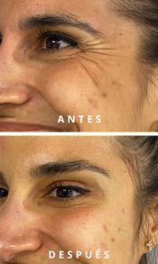 Comparativa antes y después de bótox en patas de gallo para suavizar arrugas dinámicas y rejuvenecer la mirada.