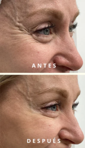 Comparativa antes y después de bótox para patas de gallo, suavizando las arrugas de expresión del contorno ocular.
