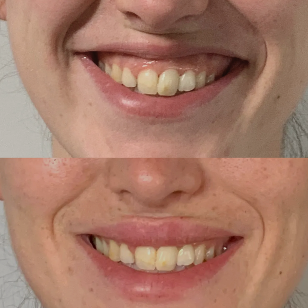 Antes y después de tratamiento con bótox para sonrisa gingival, reduciendo la exposición de encía al sonreír en Bloome.