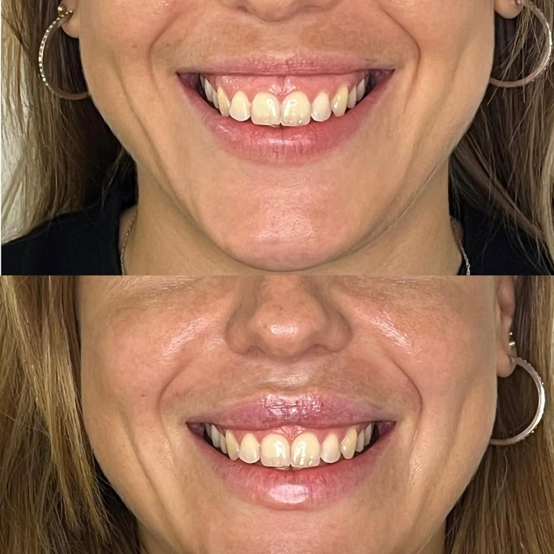 Antes y después de tratamiento con bótox para sonrisa gingival, reduciendo la exposición de encía al sonreír en Bloome.