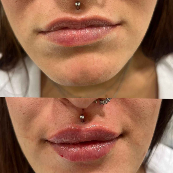 Comparativa antes y después de tratamiento con bótox en la zona perioral para suavizar gestos y mejorar la armonía del labio superior.