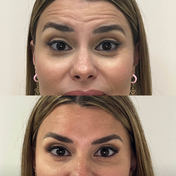 Comparativa antes y después de neuromoduladores en frente, entrecejo y zona de la mirada para suavizar arrugas dinámicas.